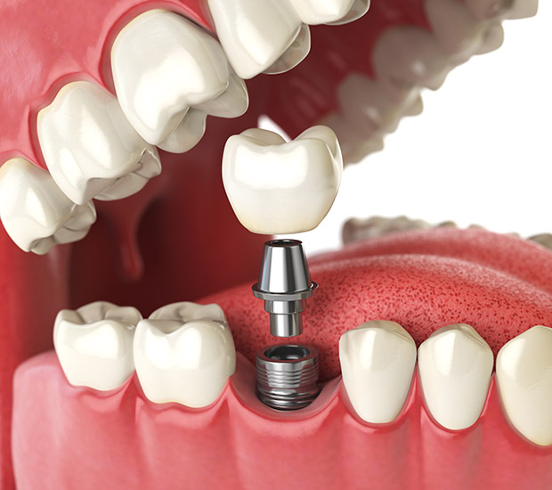 Georgetown Will I Need a Bone Graft for Dental Implants