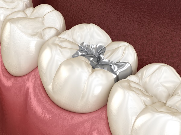Does Getting A Dental Filling Hurt?