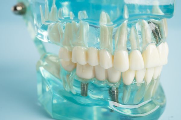 Signs It Is Time To Replace A Dental Implant Restoration
