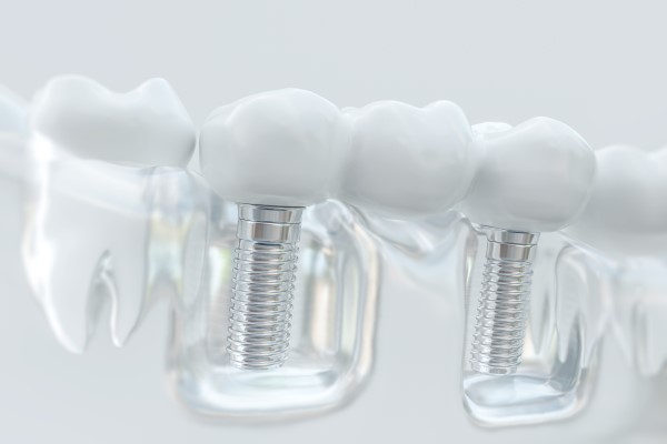 Why You Should Consider A Dental Implant For Tooth Replacement