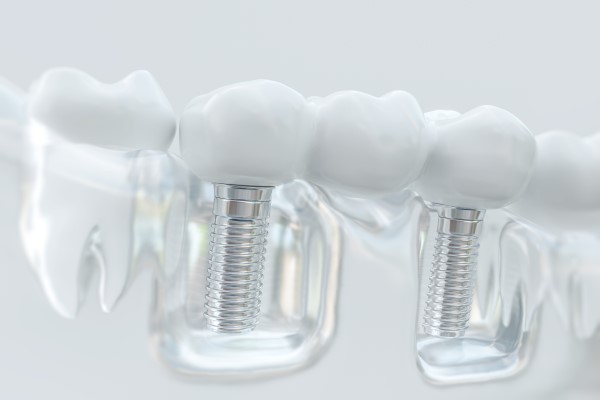 Why You Should Consider A Dental Implant For Tooth Replacement