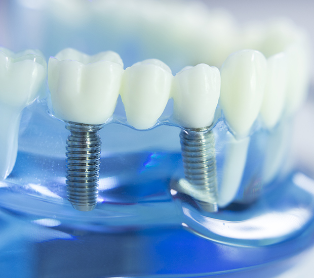 Georgetown Dental Partners Implants