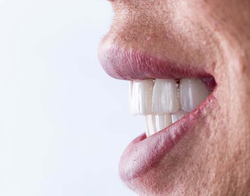 Common Questions And Answers About Implant Supported Dentures